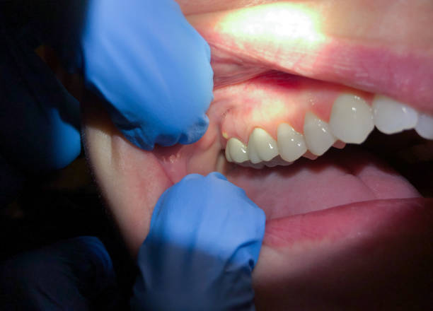Best Emergency Wisdom Teeth Removal in Stanton, KY