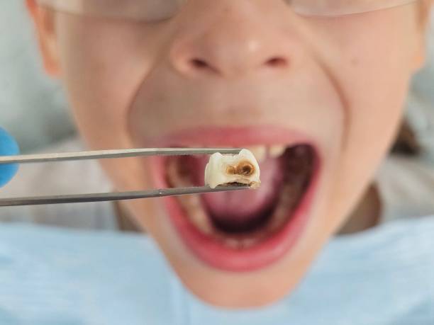 Best Emergency Treatment for Toothache in Stanton, KY